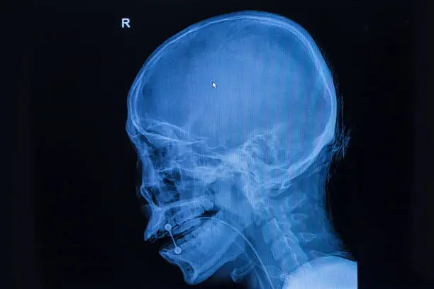 Photo of film x-ray skull and cervical spine lateral view