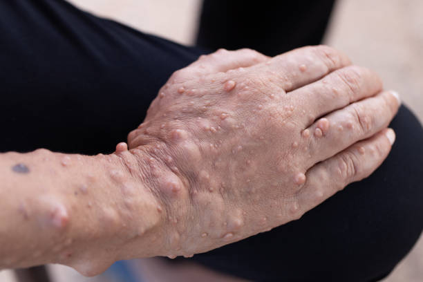 Neurofibromatosis neurofibromatosis-Causes-Types-Diagnosis-Allopathic and Homeopathic Treatment | Homeopathic | Best Homeopathic Doctor in Pakistan | Dr Qaisar Ahmed MD, DHMS