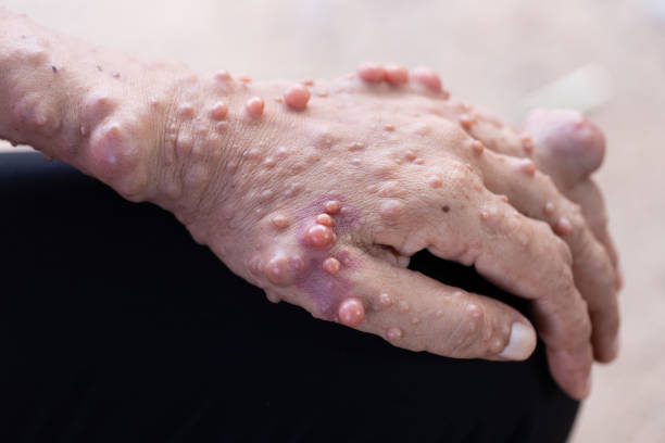 神経線維腫 (nf) は腫瘍の成長の条件、症状には皮膚に光の茶色の斑点が含まれます。 - nerve cell healthcare and medicine research human hand ストックフォトと画像
