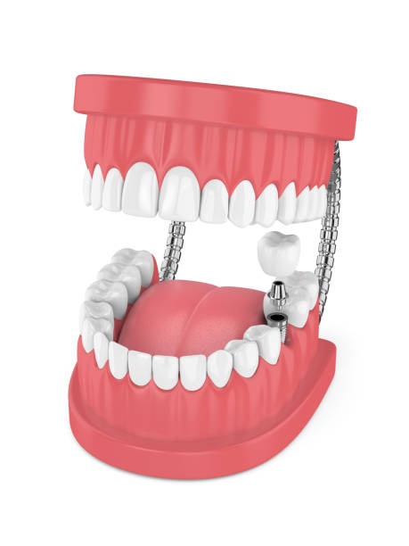 istock 3d render of jaw with teeth and dental molar implant 946766032