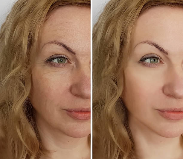 face woman wrinkles before and after face woman wrinkles before and after botox before and after stock pictures, royalty-free photos & images