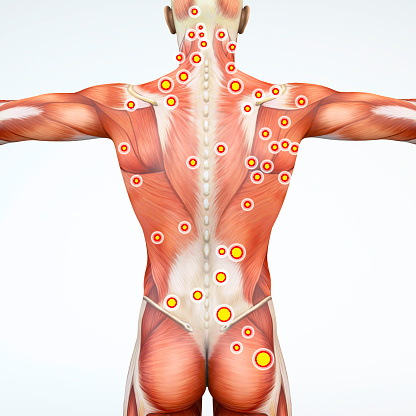 Back view of a man and his trigger points. Anatomy muscles. 3d rendering
Myofascial trigger points, are described as hyperirritable spots in the fascia surrounding skeletal muscle. Palpable nodules in taut bands of muscle fibers