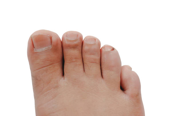 Toenail Pus Stock Photos, Pictures & Royalty-Free Images - iStock Toenail Pus Stock Photos, Pictures & Royalty-Free Images - iStock