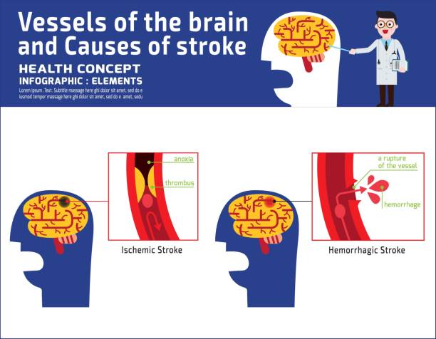 脳卒中インフォ グラフィック病医療イラストの原因脳の血管。バナー ヘッダー ヘルスケアの概念。ベクター アイコン フラット漫画デザイン分離された白い背景の上。 - anoxia点のイラスト素材／クリップアート素材／マンガ素材／アイコン素材
