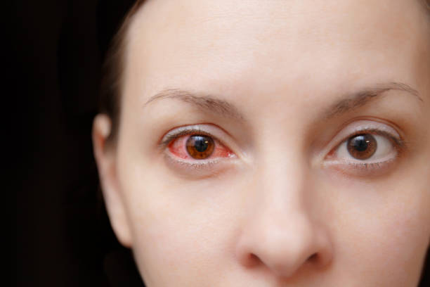 한 화가 붉은 피와 건강 눈의 여성 독감, 감기 또는 알레르기 결막염에 의해 영향을의 닫습니다. 질병과 치료의 개념입니다. 광고에 대 한 공간을 복사 합니다. 텍스트에 대 한 장소 - contact lens human eye human face women 뉴스 사진 이미지