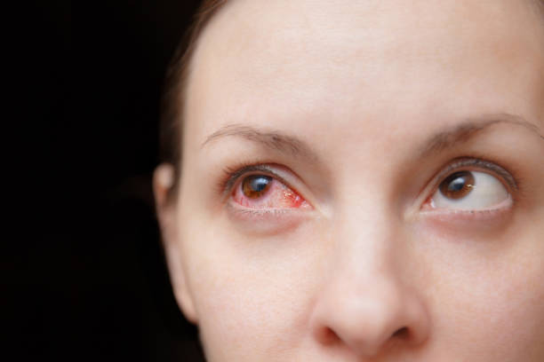 한 화가 붉은 피와 건강 눈의 여성 독감, 감기 또는 알레르기 결막염에 의해 영향을의 닫습니다. 질병과 치료의 개념입니다. 광고에 대 한 공간을 복사 합니다. 텍스트에 대 한 장소 - contact lens human eye human face women 뉴스 사진 이미지
