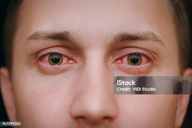 Nahaufnahme Von Zwei Verärgert Rotes Blut Augen Eines Mannes Von Bindehautentzündung Betroffen Stockfoto und mehr Bilder von Auge