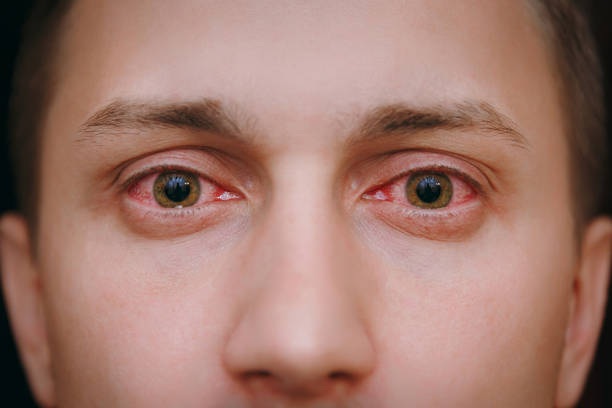결막염에 의해 영향을 받는 남자의 두 화가 붉은 피가 눈의 클로즈업 - contact lens human eye human face women 뉴스 사진 이미지