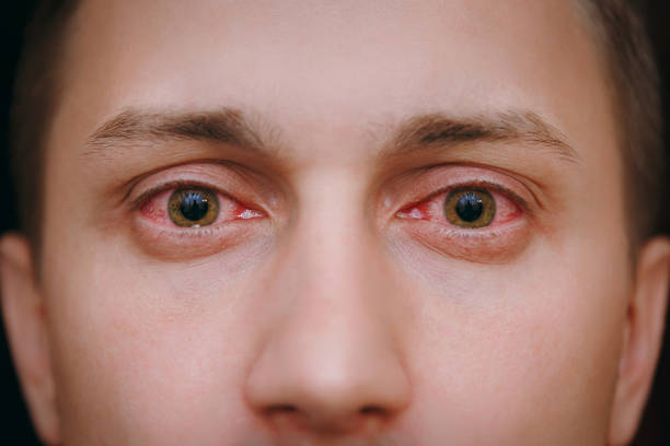 Close up of two annoyed red blood eyes of a man affected by conjunctivitis The close up of two annoyed red blood eyes of a man affected by conjunctivitis itching on a photograph pictures stock pictures, royalty-free photos & images