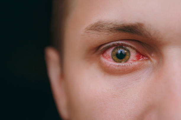 結膜炎によって影響を受ける人間の腹の赤い血片目のクローズ アップ - 人間の眼 ストックフォトと画像