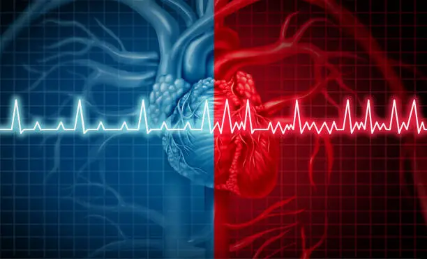 Photo of Atrial Fibrillation