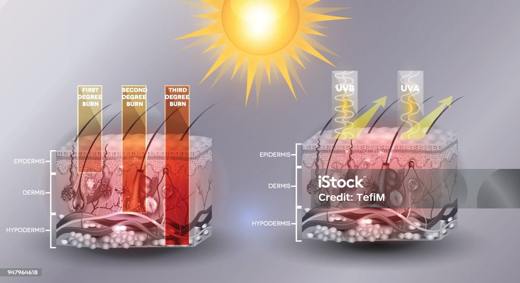Sun Burn Classification Sunburn Stock Illustration - Download Image Now - Skin, Damaged ...