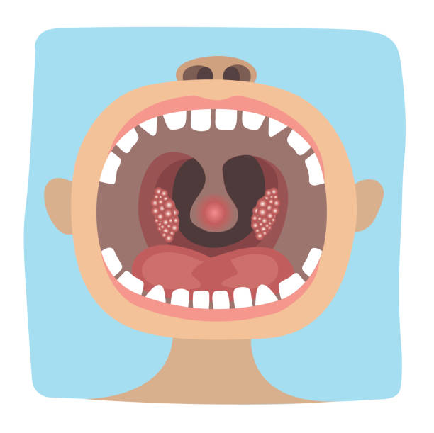 illustrazioni stock, clip art, cartoni animati e icone di tendenza di poster infografica illustrazione di una sana differenza di gola dalla tonsillite - ugola
