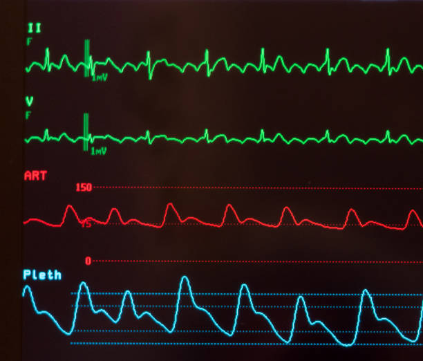 istock Close Up of an ECG with Atrial Flutter 948301736