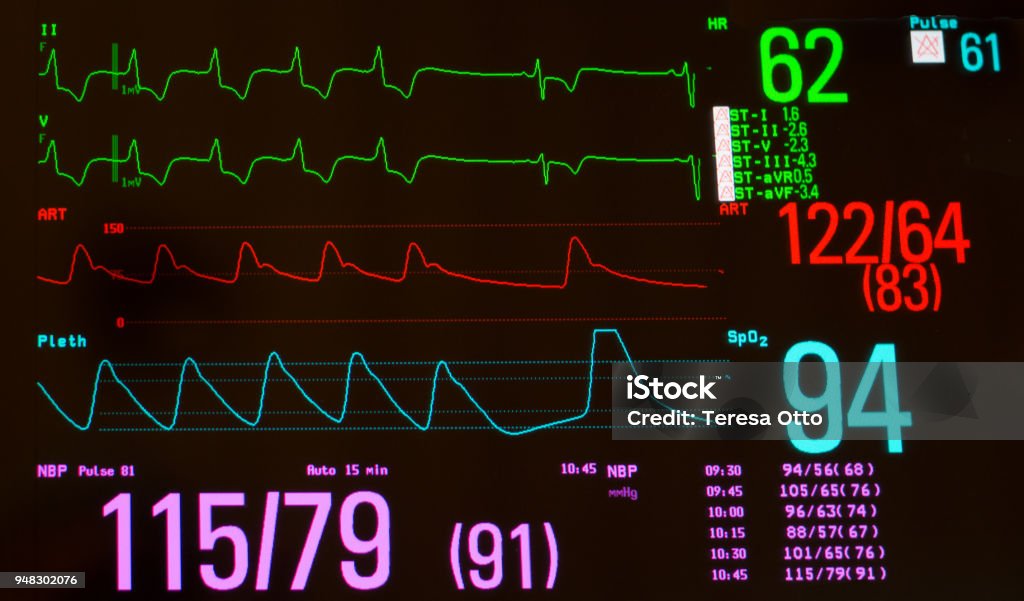 Close Up of Heart Monitor with Paced Rhythm and Sinus Bradycardia A black screened medical monitor showing a paced heart rhythm followed by sinus bradycardia in green, arterial blood pressure in red, oxygen saturation in blue, non invasive blood pressure in lavender. Analyzing Stock Photo