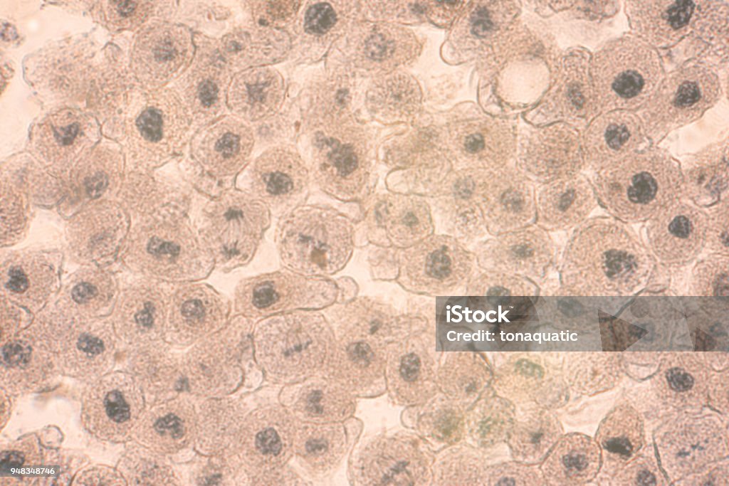 Squamous epithelial cells under microscope view for education histology. Squamous epithelial cells under microscope view for education histology. Human tissue. Adenocarcinoma Stock Photo