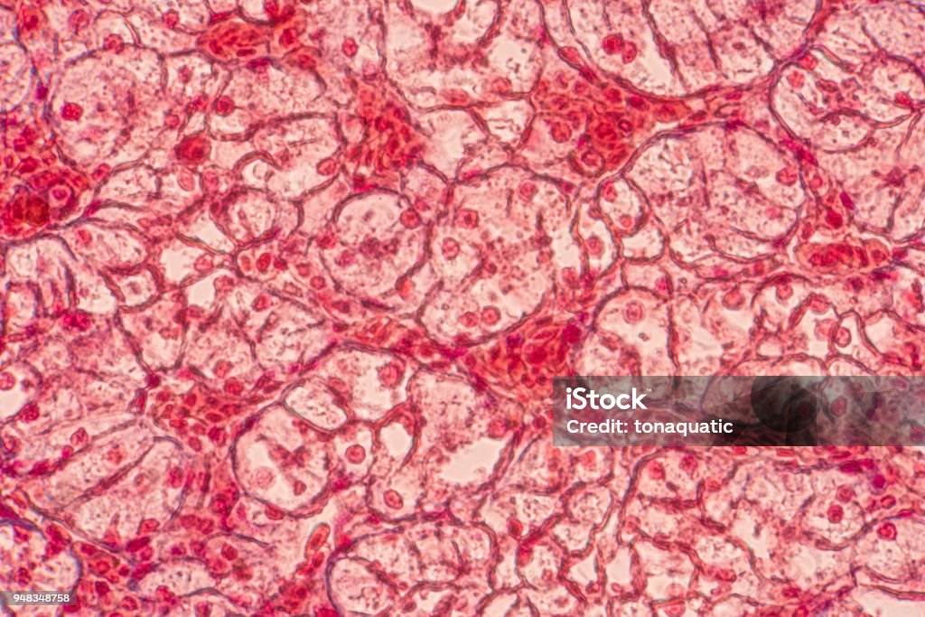 Plattenepithelkarzinome Epithelzellen unter Mikroskop anzeigen für Bildung Histologie. - Lizenzfrei Mikroskop Stock-Foto