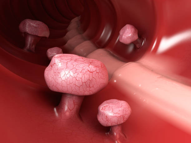 istock 3d illustration of Colon polyps. Polyp in the intestine. isolated white 948362314