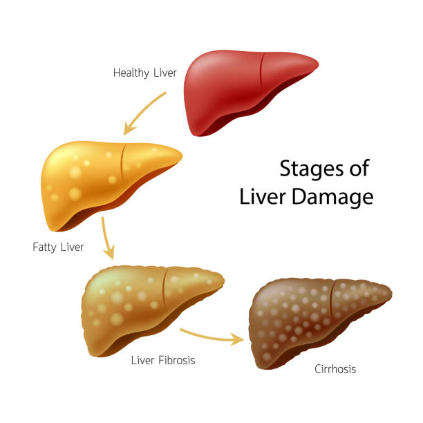 Stages of liver damage. Liver Disease. Healthy liver, fatty liver, liver fibrosis and Cirrhosis. Illustration info-graphic, isolated on white background. scarification stock illustrations