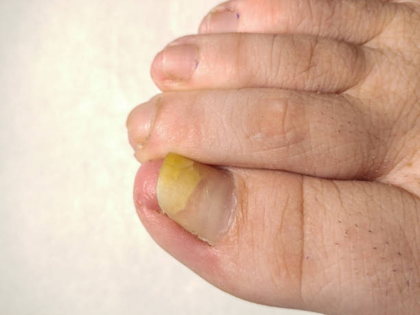 istock Yellow Toenail Syndrome. Closeup. 948781978