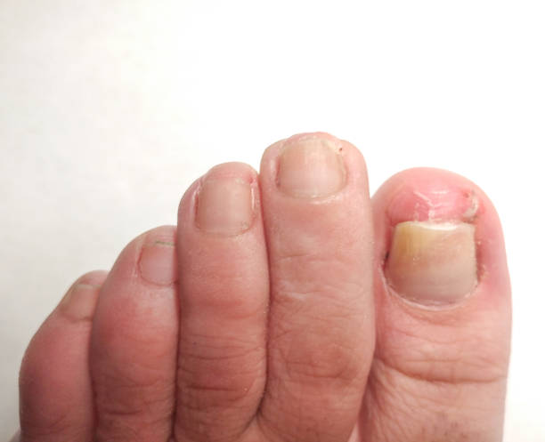 istock Yellow Toenail Syndrome. Closeup. 948782030