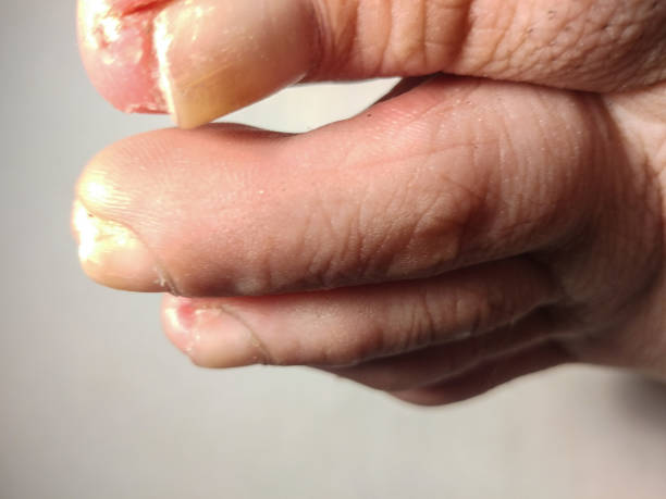 istock Yellow Toenail Syndrome. Closeup. 948782450