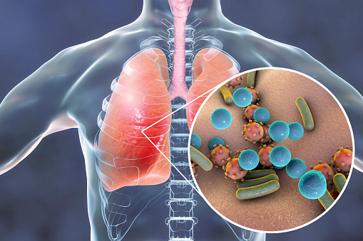 Neumonía, concepto médico, los pulmones de ilustración que muestra y opinión del primer de los microbios en los pulmones photo
