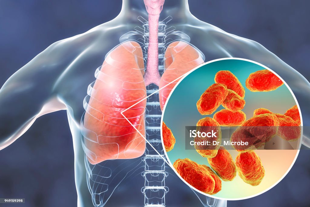 Pneumonia caused by Haemophilus influenzae bacteria, medical concept Pneumonia caused by Haemophilus influenzae bacteria, medical concept, 3D illustration. Gram-negative coccobacilli, the causative agents of pneumonia and infections of other location Haemophilus Influenzae Stock Photo
