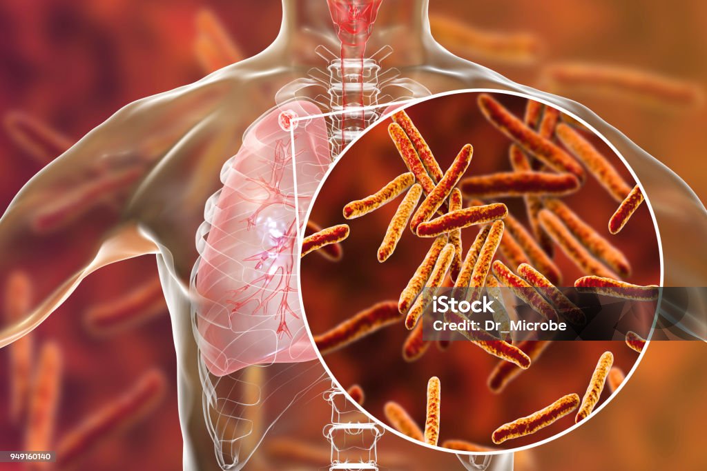 Secondary tuberculosis in lungs and close-up view of Mycobacterium tuberculosis bacteria Secondary tuberculosis in lungs and close-up view of Mycobacterium tuberculosis bacteria, 3D illustration Tuberculosis Bacterium Stock Photo