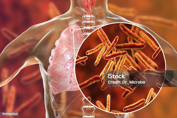 Secondary Tuberculosis In Lungs And Closeup View Of Mycobacterium Tuberculosis Bacteria Stock Photo - Download Image Now