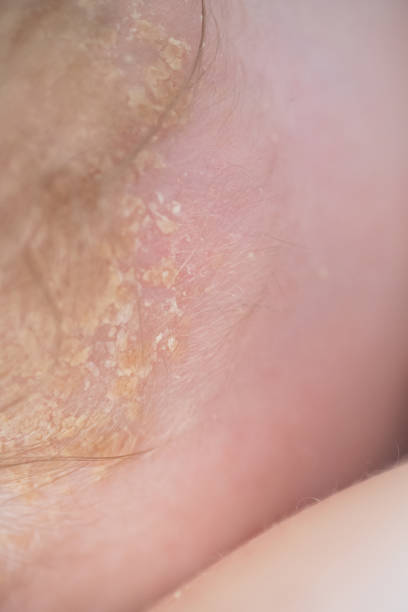 istock Cradle Cap on baby head skin 949171956