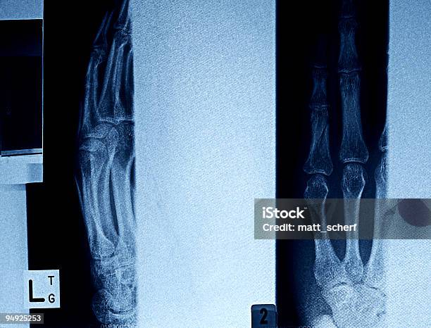 Xray Grunge Blue Fingers Stock Photo - Download Image Now - Abstract, Human Bone, Physical Injury