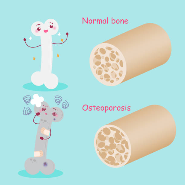 Bone With Health Concept Stock Illustration - Download Image Now -  Osteoporosis, Bone, Healthy Lifestyle - iStock