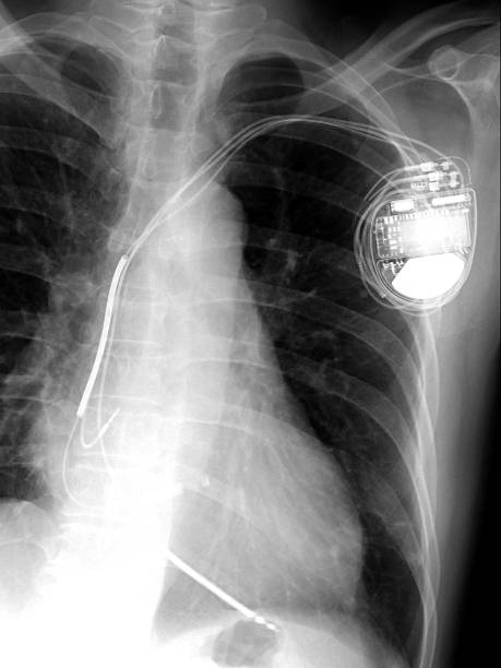 istock x-ray image of permanent pacemaker implant in chest body 949351638