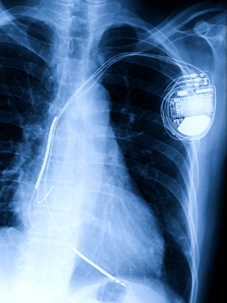 胸体、青のトーンでプロセスでインプラントの恒久的ペース メーカーの x 線像 - surgery catheter cardiac catheterization hospital ストックフォトと画像