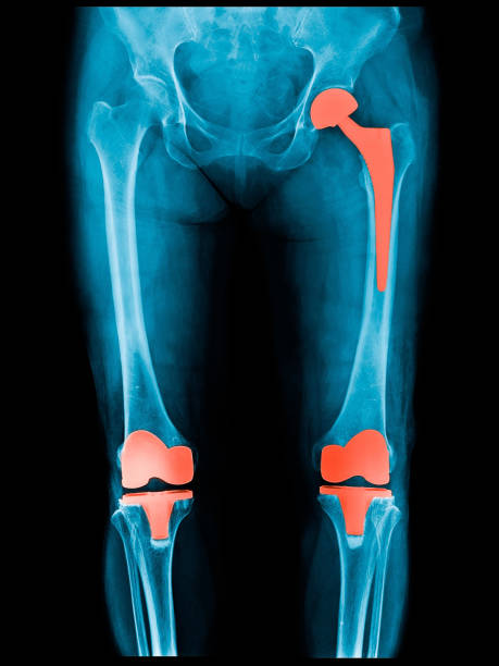 Xray scan of patient who have hip replacement and knee arthroplasty (knee replacement) treatment for Osteoarthritis knee, hip arthritis, Osteonecrosis of Hip. After surgery patient can walk normally Xray scan of patient who have hip replacement and knee arthroplasty (knee replacement) treatment for Osteoarthritis knee, hip arthritis, Osteonecrosis of Hip. After surgery patient can walk normally artificial knee photos stock pictures, royalty-free photos & images