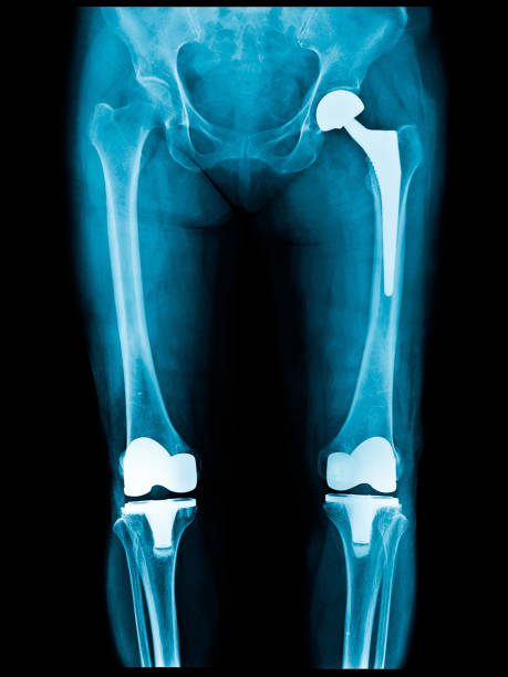 xray scan of patient who have hip replacement and knee arthroplasty (knee replacement) treatment for osteoarthritis knee, hip arthritis, osteonecrosis of hip. after surgery patient can walk normally - human joint human knee pain x ray imagens e fotografias de stock