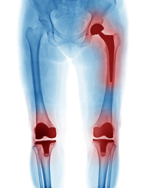 istock X Ray image of hip replacement and knee replacement isolated on white background 949351910