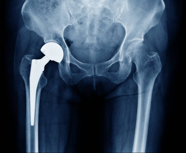 scan röntgenaufnahme der hüftgelenke mit orthopädischen hüftgelenkersatz oder totale hüftprothese rechts implantat kopf und schrauben in menschlichen skeletts in grau-blautönen. - hip replacement stock-fotos und bilder