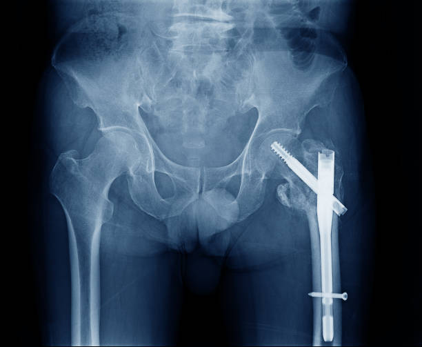 X-ray image of left side human hip fracture neck of femur bone. Open Reduction Internal Fixation with internal bone rod and screw by Orthopedic surgeon X-ray image of left side human hip fracture neck of femur bone. Open Reduction Internal Fixation with internal bone rod and screw by Orthopedic surgeon hip joint x stock pictures, royalty-free photos & images