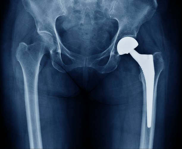 scan-röntgenaufnahme der hüftgelenke mit orthopädischen hüftgelenkersatz implantat kopf und schrauben in menschlichen skeletts in grau-blautönen. krankenhausklinik für orthopädie traumatologie chirurgie eingescannt. - hip replacement stock-fotos und bilder