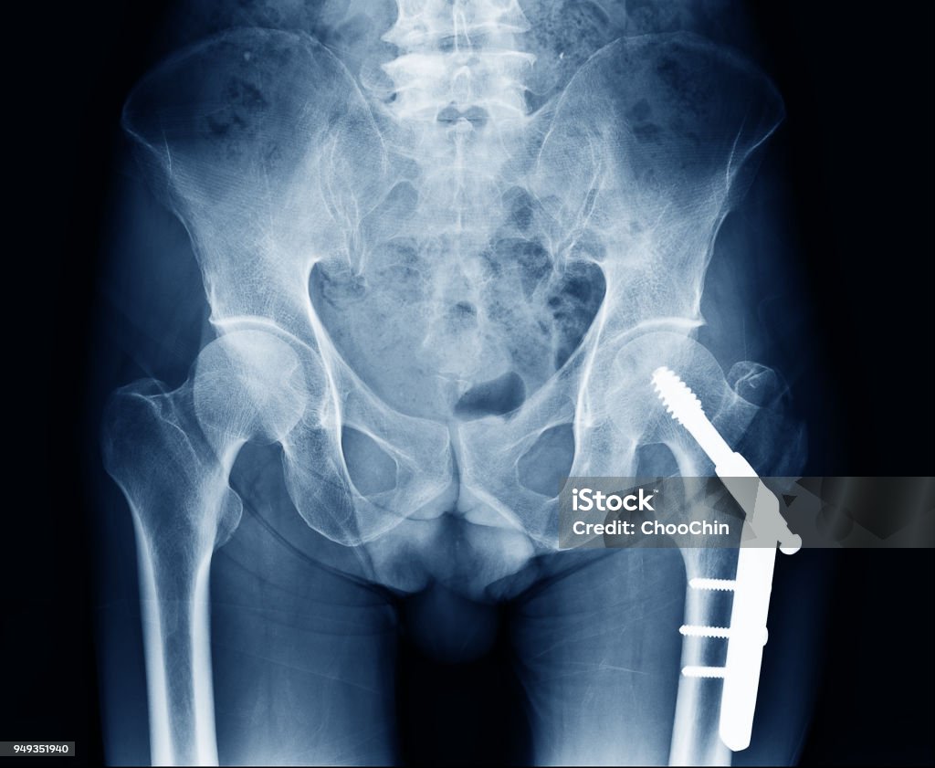 Xray Image Of Human Left Side Hip Fracture Neck Of Femur Bone Open  Reduction Internal Fixation With Internal Bone Rod Plate And Screw By  Orthopedic Surgeon Stock Photo - Download Image Now 