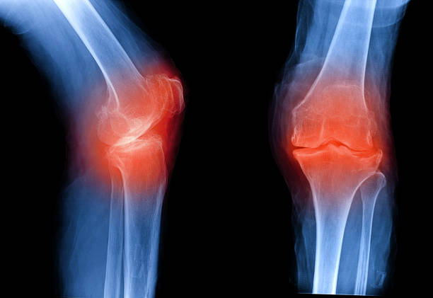 Osteoarthritis knee . film x-ray AP ( anterior - posterior ) and lateral view show narrow joint space, osteophyte ( spur ), subchondral sclerosis, inflammation, OA Osteoarthritis knee . film x-ray AP ( anterior - posterior ) and lateral view show narrow joint space, osteophyte ( spur ), subchondral sclerosis, inflammation, OA osteoarthritis photos stock pictures, royalty-free photos & images
