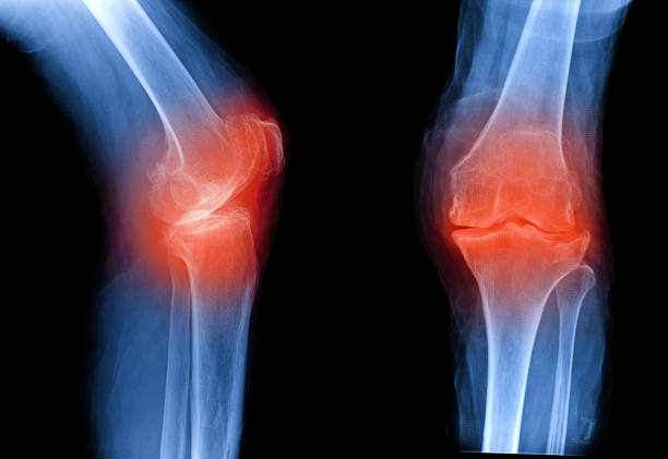 osteoarthritis knee . film x-ray ap ( anterior - posterior ) and lateral view show narrow joint space, osteophyte ( spur ), subchondral sclerosis, inflammation, oa - osteoarthritis doctor medicine healthcare and medicine imagens e fotografias de stock