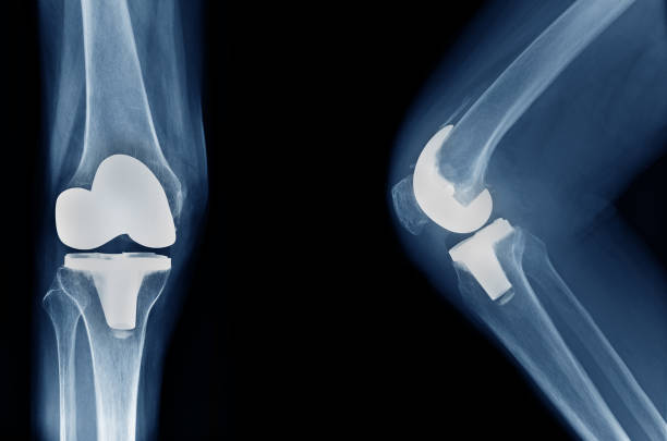 x-ray show knee joint replacement / knee arthroplasty front view and side view x-ray show knee joint replacement / knee arthroplasty front view and side view atrophy photos stock pictures, royalty-free photos & images
