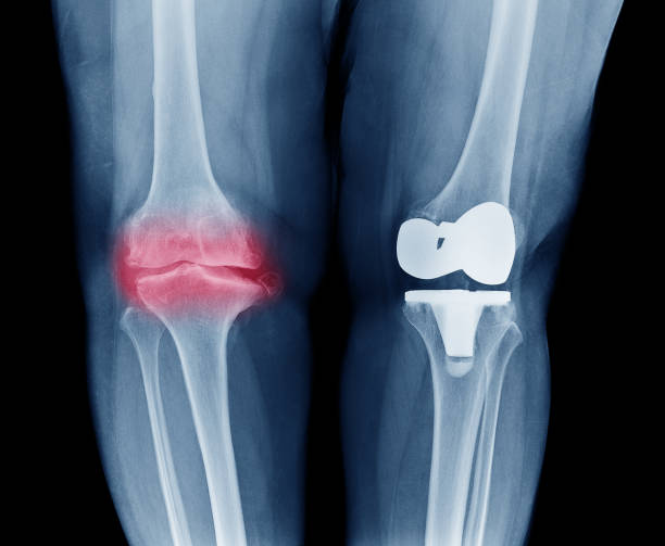 X-ray image photo of Osteoarthritis Knee ( OA Knee ) most common cause of elderly knee painful on right knee mark with red color and left knee have joint arthroplasty fix Osteoarthritis knee foto de imagen de rayos x de la causa más común de artrosis de rodilla (oa de la rodilla) de ancianos rodilla dolorosa en la rodilla derecha marca con color rojo y la rodilla izquierda tiene artroplastia común fijar la rodilla de la osteoartritis