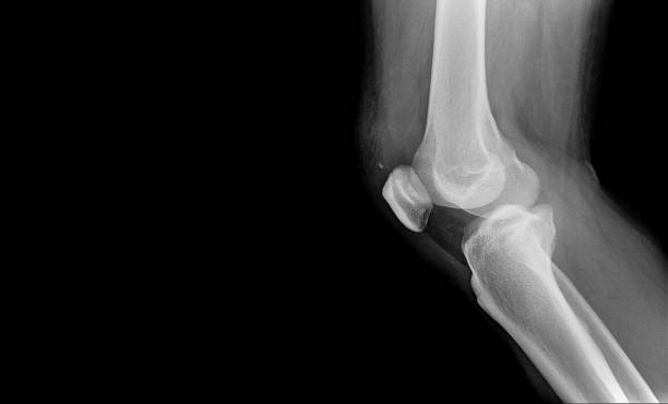 istock x-ray image of knee with left blank space to add other text 949352106