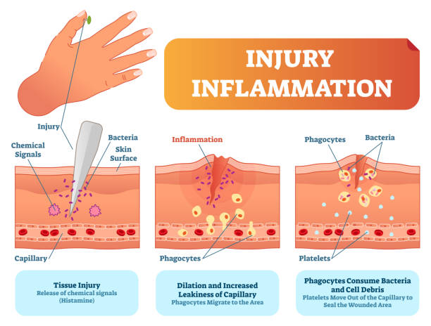 verletzungen entzündung biologischen organismus reaktion vektor illustration schema. die haut oberfläche verletzungen kreuz abschnitt poster mit kapillare, phagozyten und thrombozyten. - medizinische zeichnung stock-grafiken, -clipart, -cartoons und -symbole