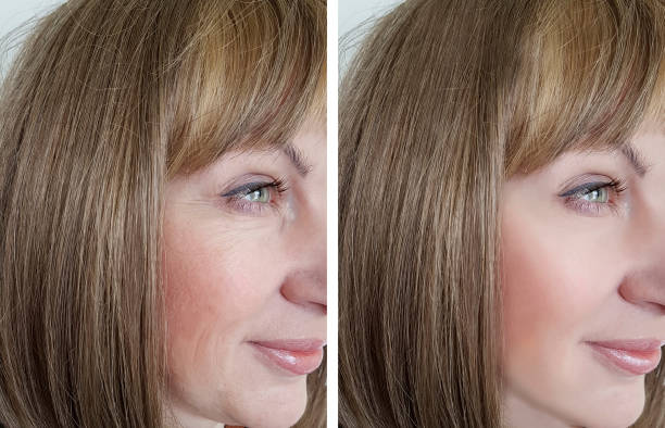 face woman wrinkles before and after procedures face woman wrinkles before and after procedures botox before and after stock pictures, royalty-free photos & images