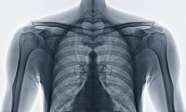 치료에 대 한 흰색 바탕에 전면 어깨. - human bone x ray image pain condition 뉴스 사진 이미지